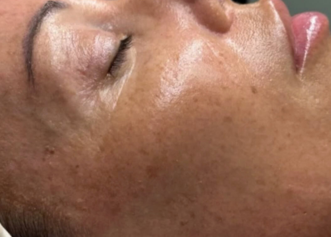 After Diamond Glow facial