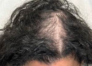 After hair restoration