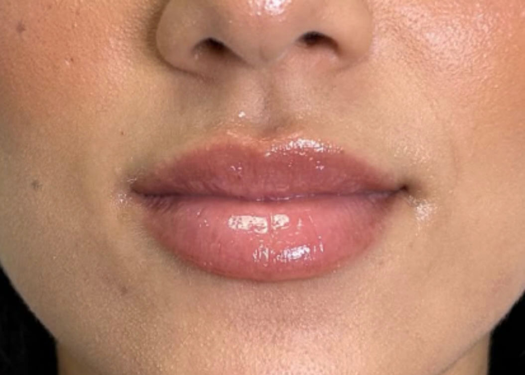 After lip filler