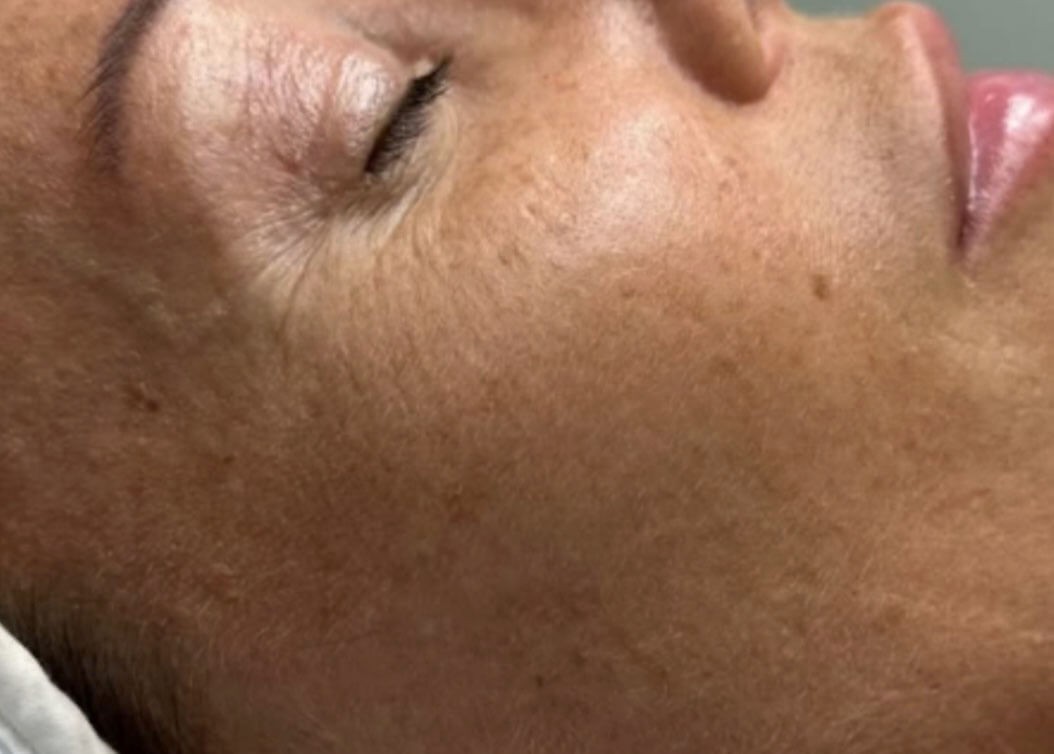 Before Diamond Glow facial