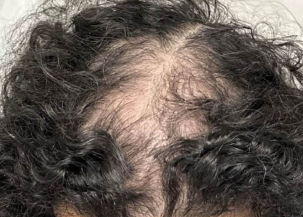 Before hair restoration