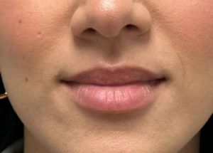 Before lip filler