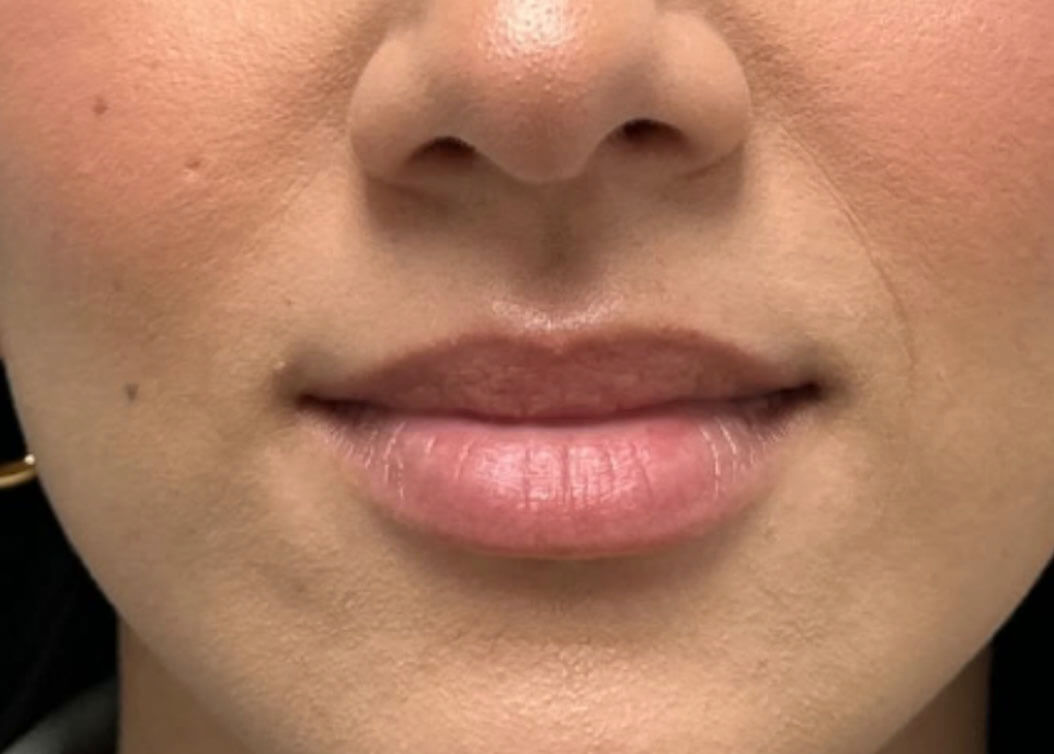 Before lip filler