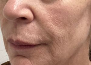 Before Sculptra