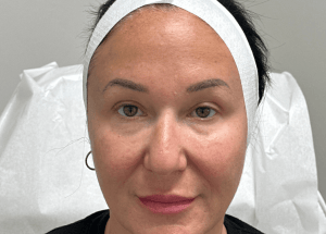 HG Morpheus8 After treatment