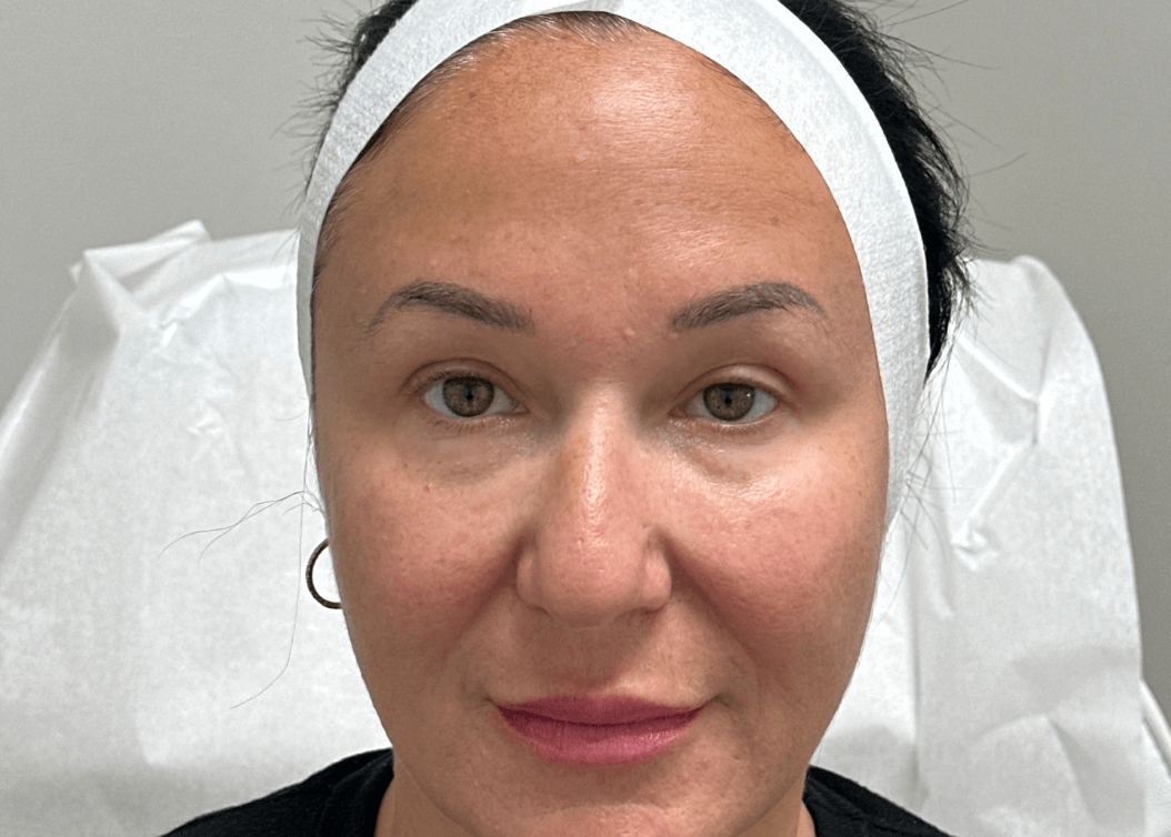 HG Morpheus8 After treatment